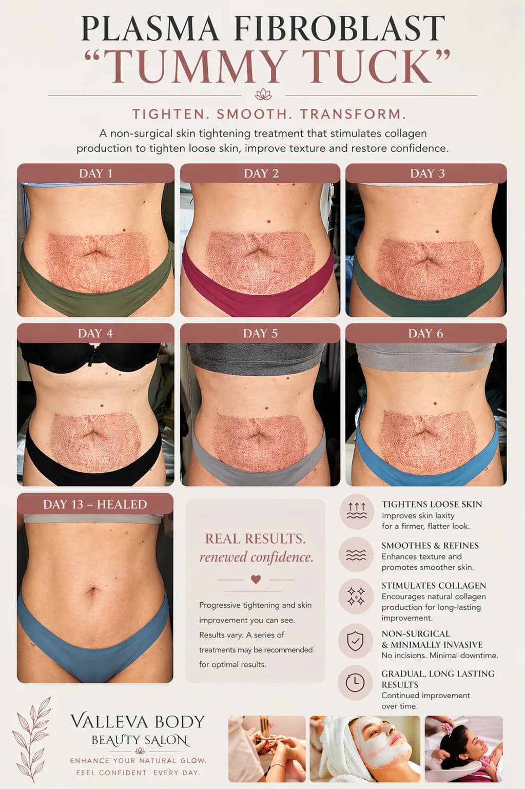 Abdominal plasma fibroblasting photographed daily from day one to day thirteen, showing the treated area crusting and then healing.