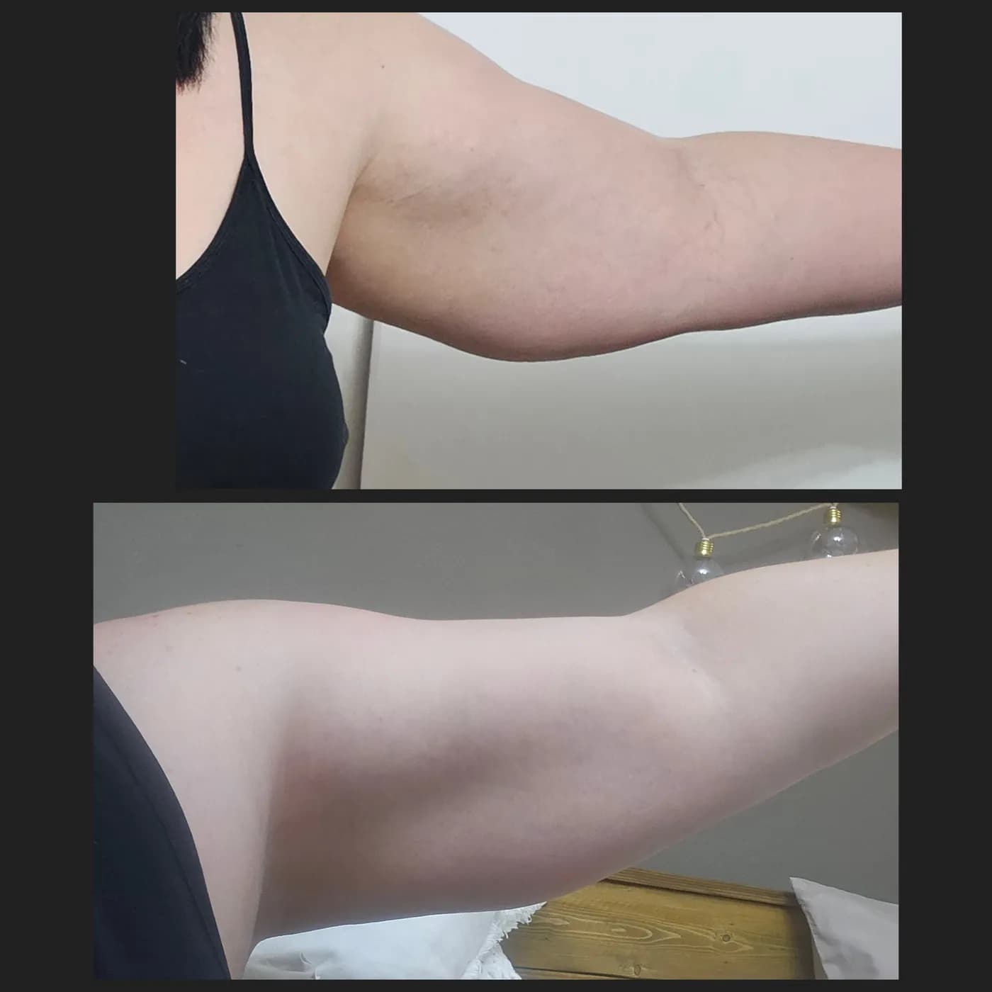 Upper arm shown before and after skin tightening treatment