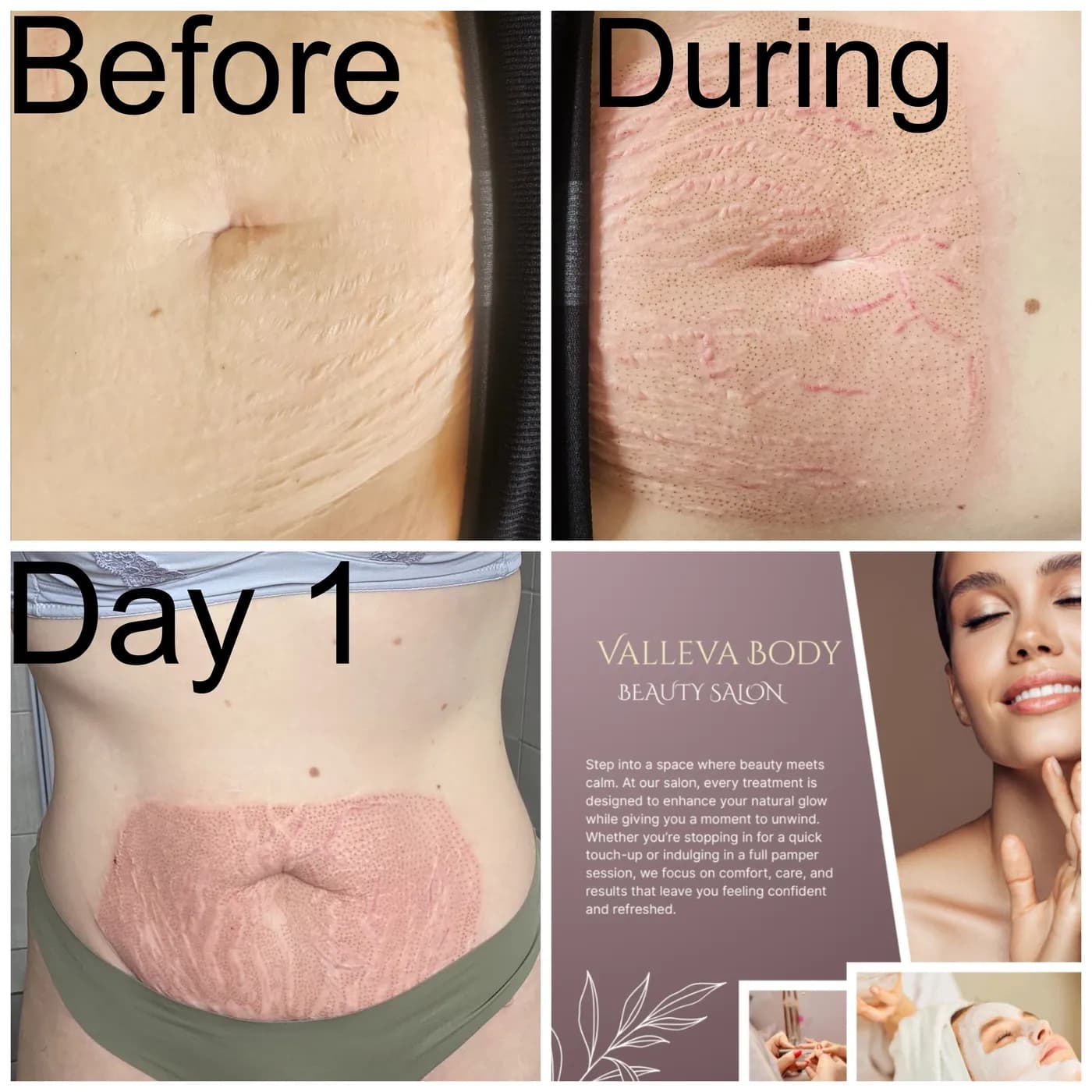 Abdominal fibroblasting shown before treatment, during treatment and on day one of healing, with the treated area visibly crusted